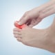 hallux rigidus